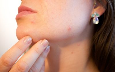 La peau et ses problèmes: boutons, acné, eczéma…